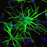 Gli astrociti che esprimono gli enzimi attivatori della vitamina D identificano la malattia di Parkinson