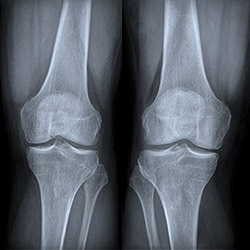 Osteoporosi e Parkinson