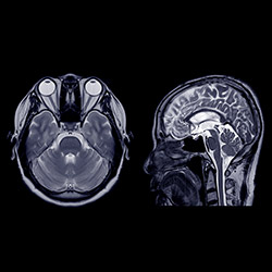 deep brain stimulation