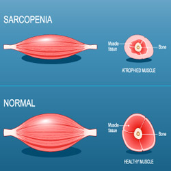 sarcopenia